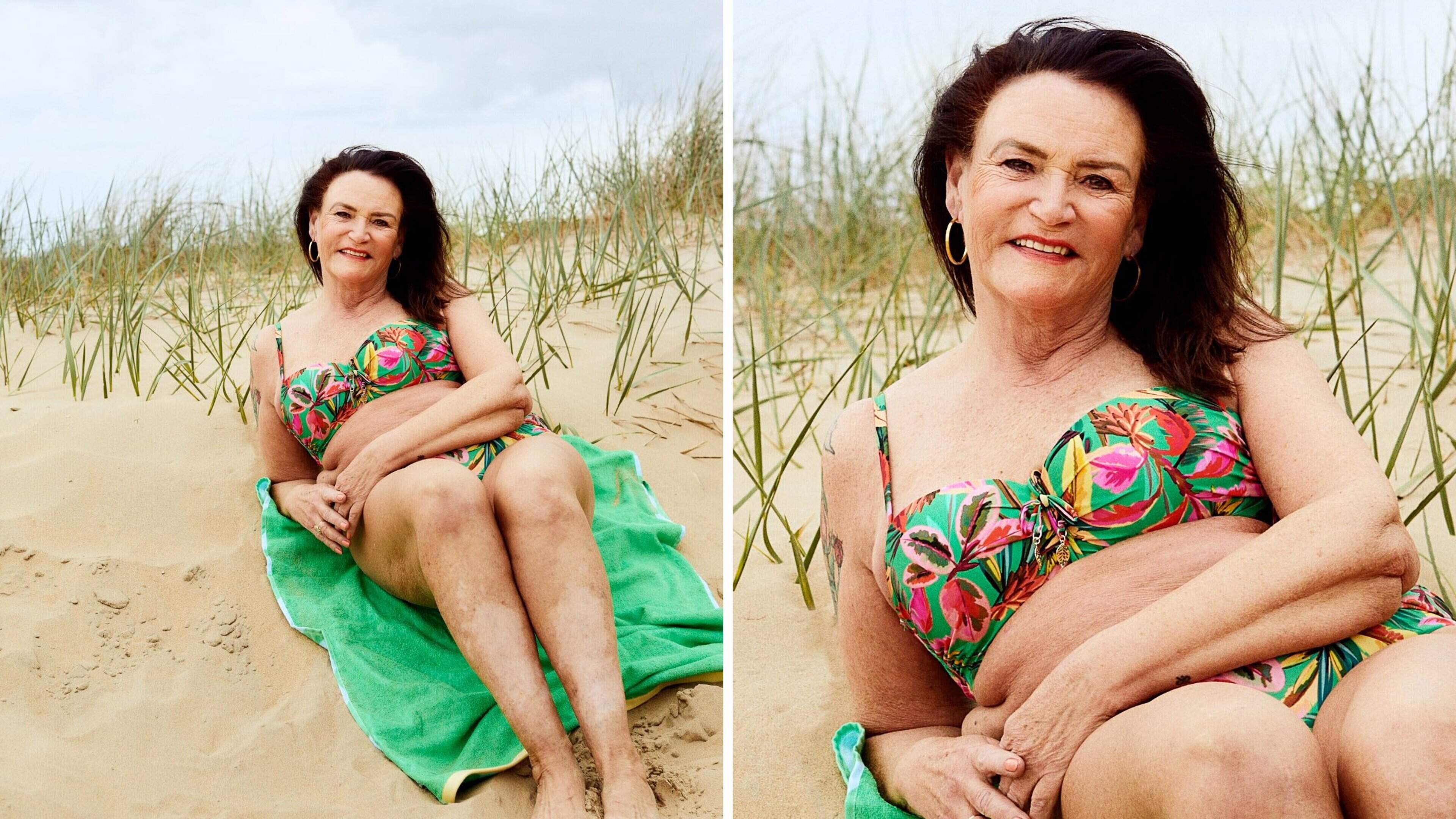 Inge (63) heeft vitiligo: ’In het begin probeerde ik de vlekken angstvallig te verbergen’