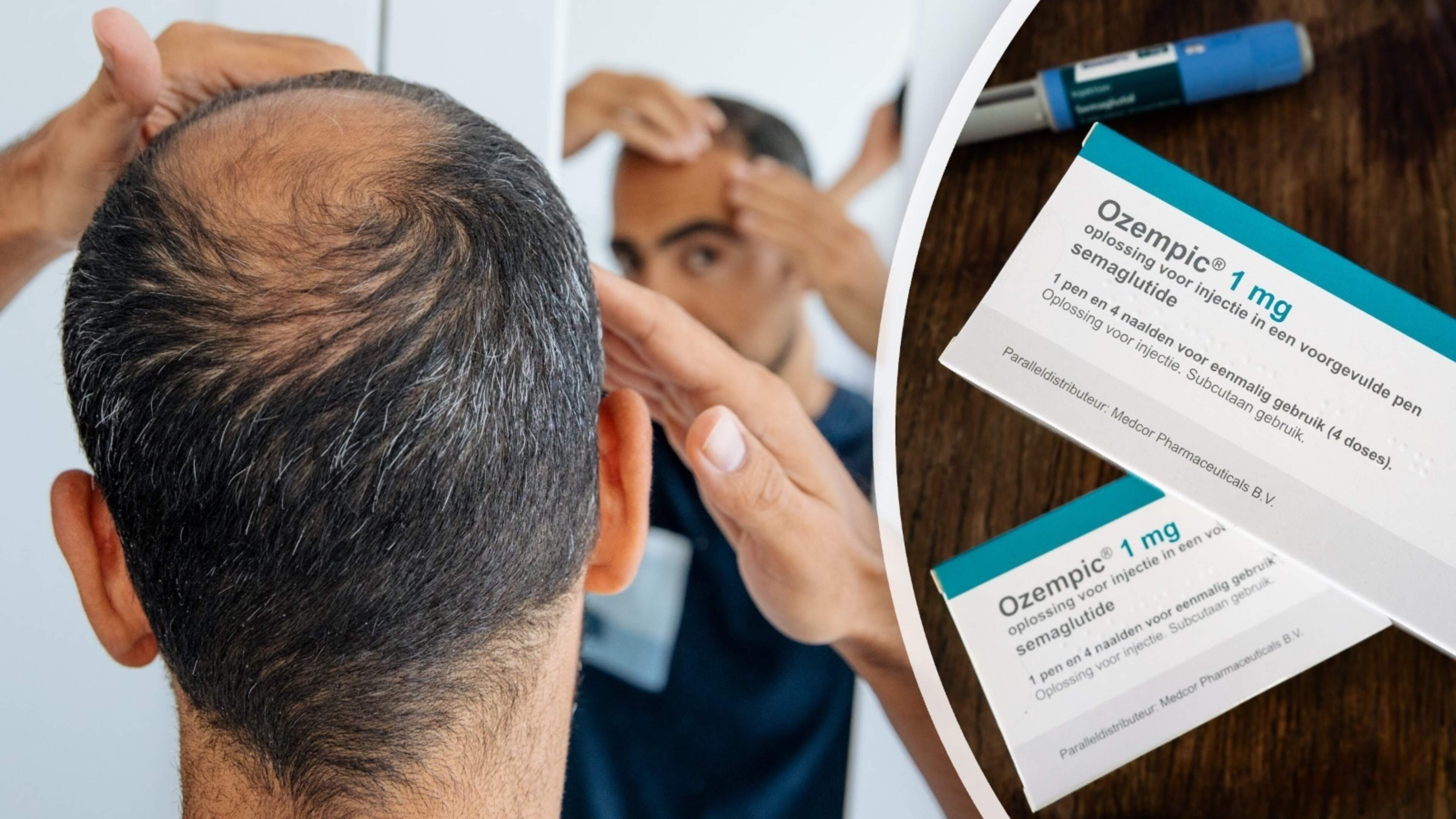 Afslankmedicatie in verband gebracht met mogelijk verhoogd risico op haaruitval, soms tot wel 68 procent meer kans