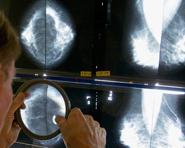 GPs’ breast cancer guidelines ‘miss’ 95% of women who will develop disease