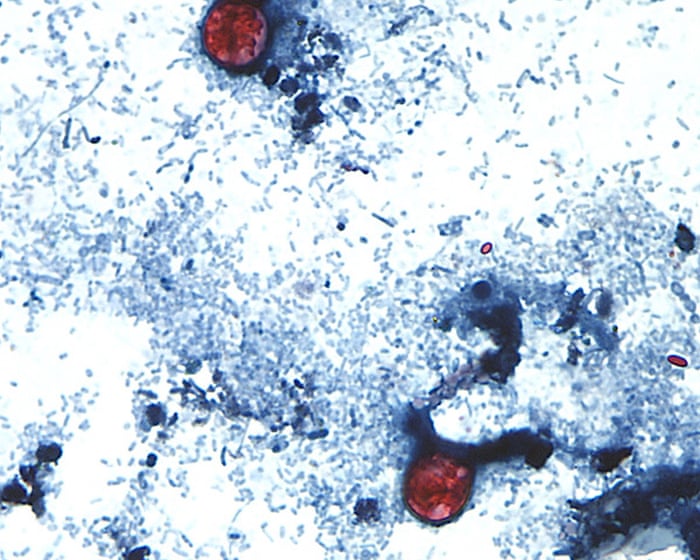US outbreak of parasite causing ‘watery diarrhea’ rises to more than 2,800 cases