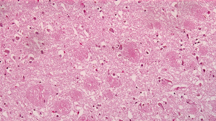 Test that could identify Alzheimer's signs 20 years earlier greenlit for trials