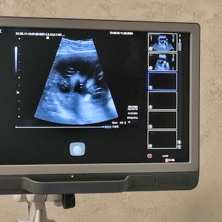 OLVG starts trial with late abortions: procedure between 22nd and 24th week is legal, but remains sensitive