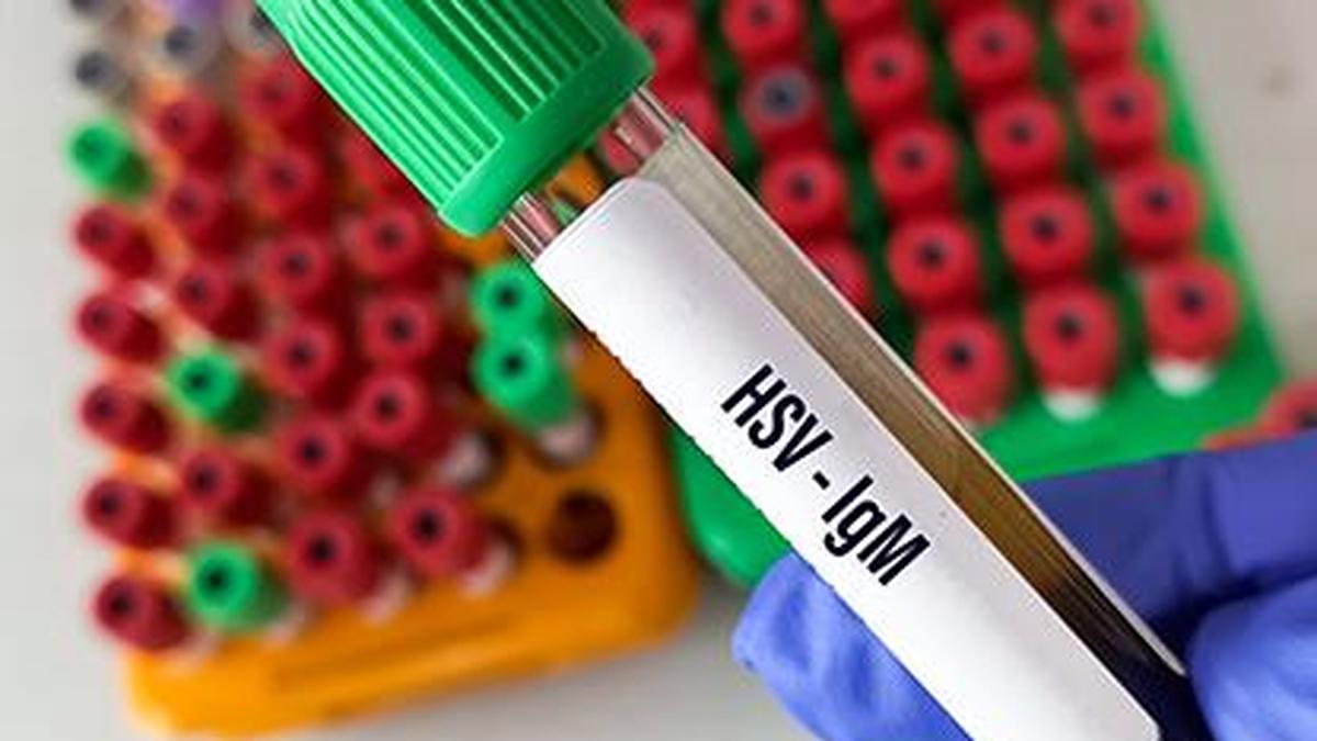 Seven dead, 92 inmates infected with herpes virus at overcrowded Jalpaiguri correctional home